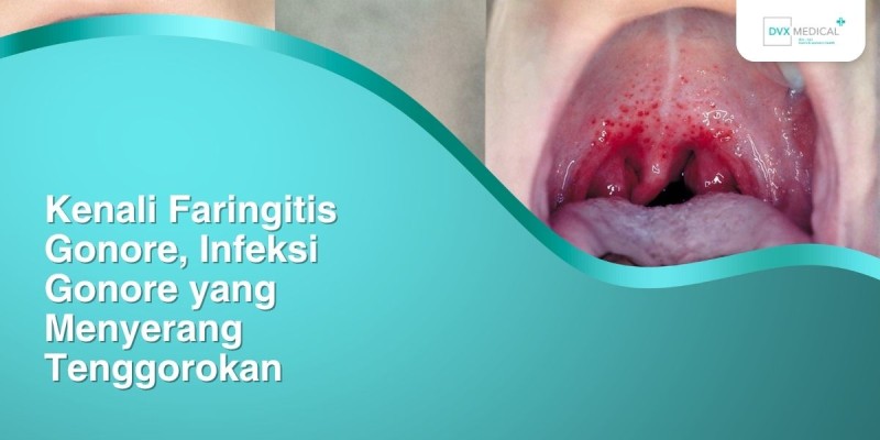 Kenali Faringitis Gonore, Infeksi Gonore yang Menyerang Tenggorokan