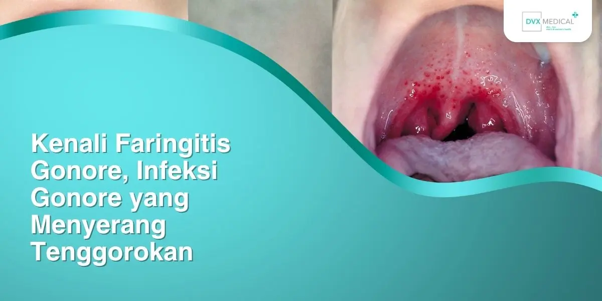 Kenali Faringitis Gonore, Infeksi Gonore yang Menyerang Tenggorokan