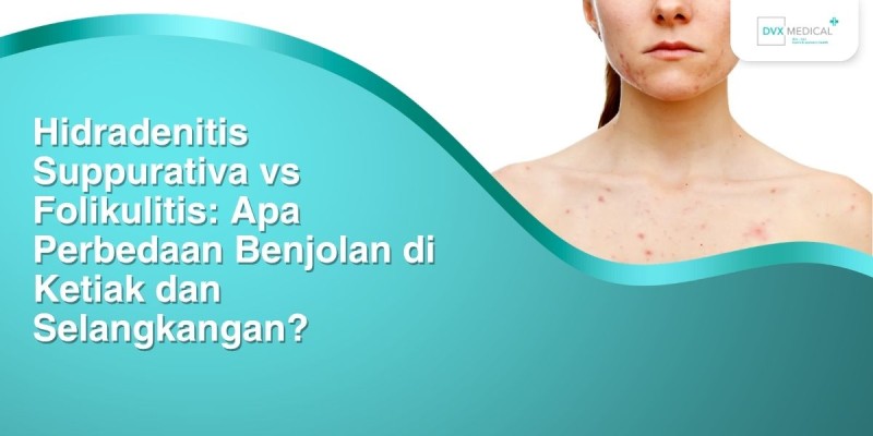 Hidradenitis Suppurativa vs Folikulitis: Apa Perbedaan Benjolan di Ketiak dan Selangkangan?