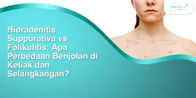 Hidradenitis Suppurativa vs Folikulitis: Apa Perbedaan Benjolan di Ketiak dan Selangkangan?