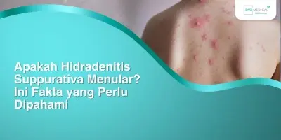 Apakah Hidradenitis Suppurativa Menular? Ini Fakta yang Perlu Dipahami