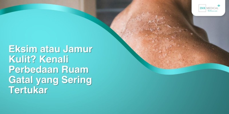 Eksim atau Jamur Kulit? Kenali Perbedaan Ruam Gatal yang Sering Tertukar