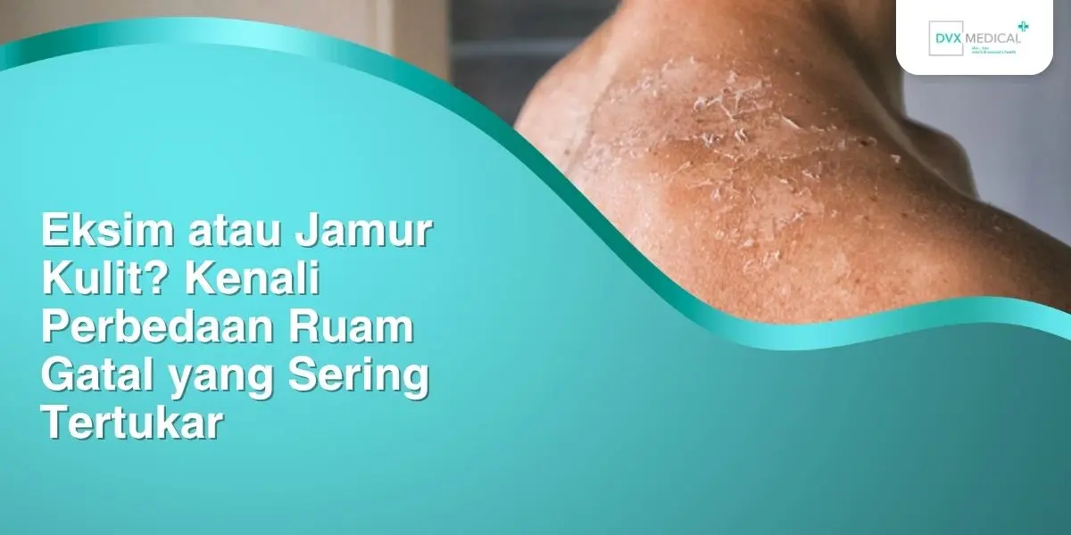 Eksim atau Jamur Kulit? Kenali Perbedaan Ruam Gatal yang Sering Tertukar