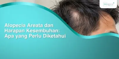 Alopecia Areata dan Harapan Kesembuhan: Apa yang Perlu Diketahui
