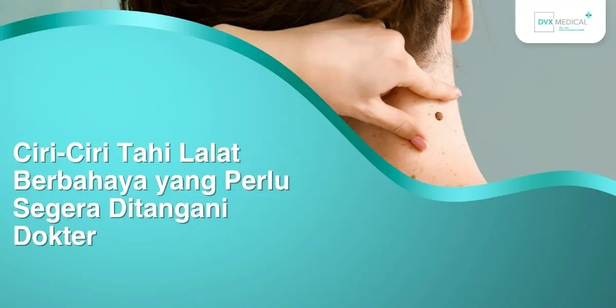 Ciri-Ciri Tahi Lalat Berbahaya yang Perlu Segera Ditangani Dokter