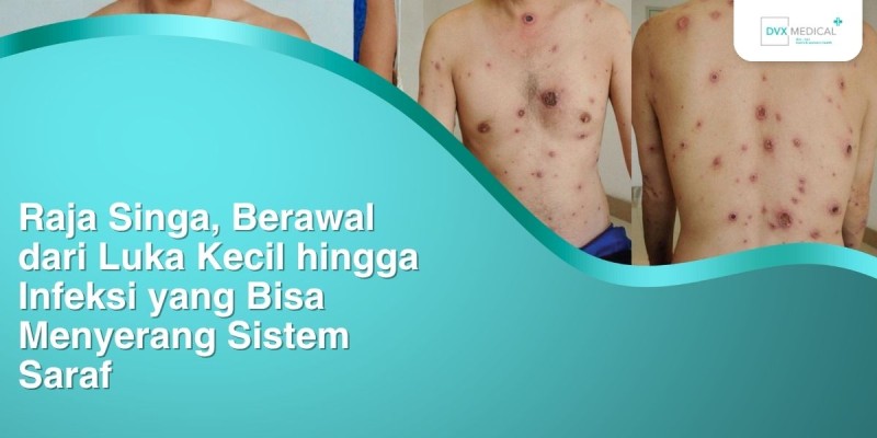 Raja Singa, Berawal dari Luka Kecil hingga Infeksi yang Bisa Menyerang Sistem Saraf
