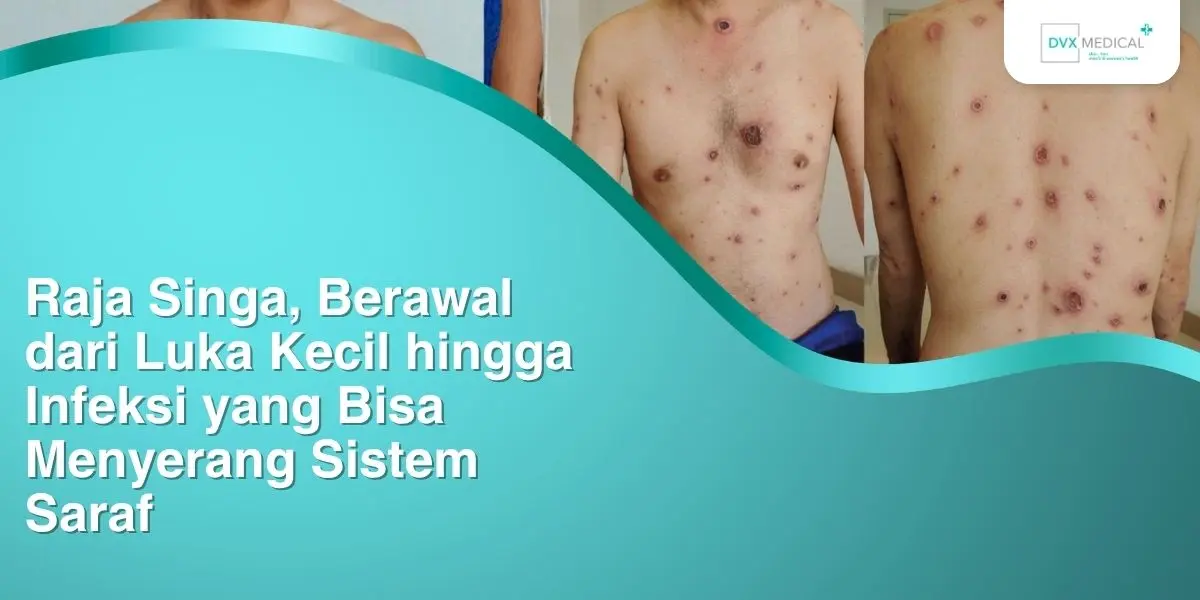 Raja Singa, Berawal dari Luka Kecil hingga Infeksi yang Bisa Menyerang Sistem Saraf