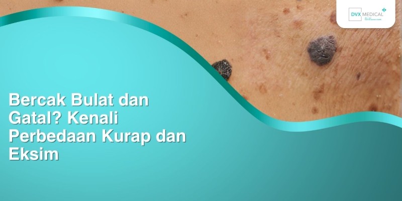 Bercak Bulat dan Gatal? Kenali Perbedaan Kurap dan Eksim