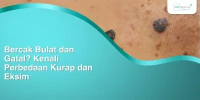 Bercak Bulat dan Gatal? Kenali Perbedaan Kurap dan Eksim