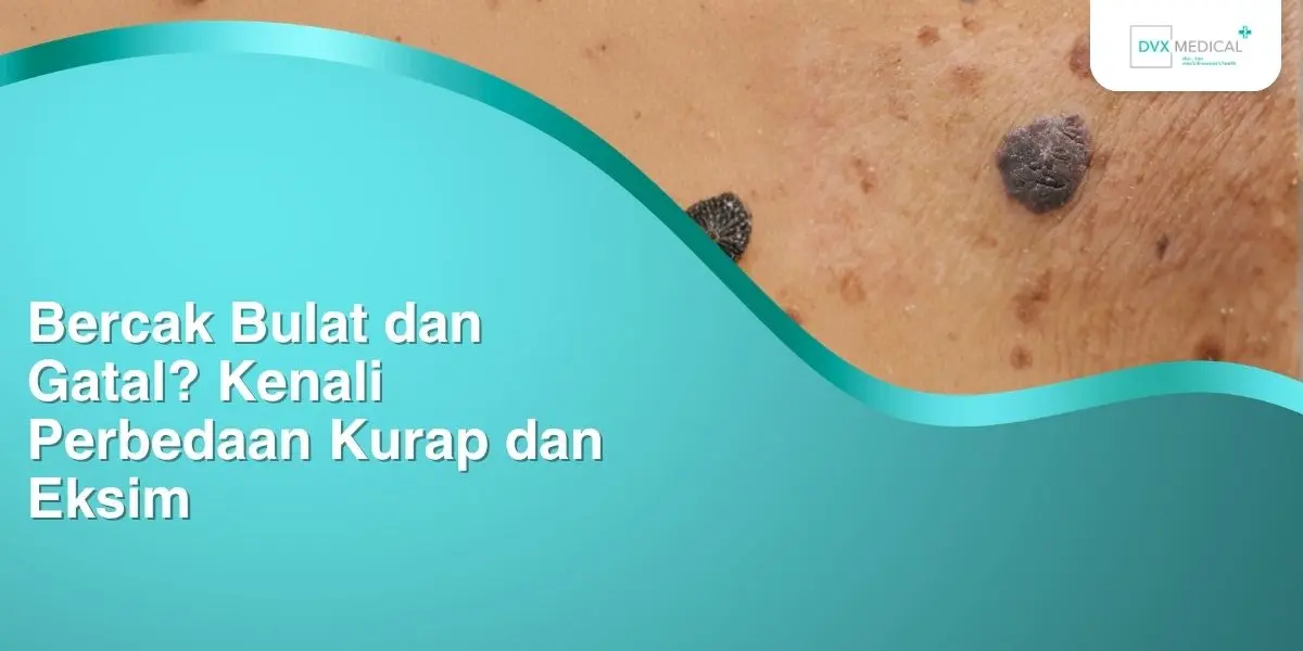 Bercak Bulat dan Gatal? Kenali Perbedaan Kurap dan Eksim