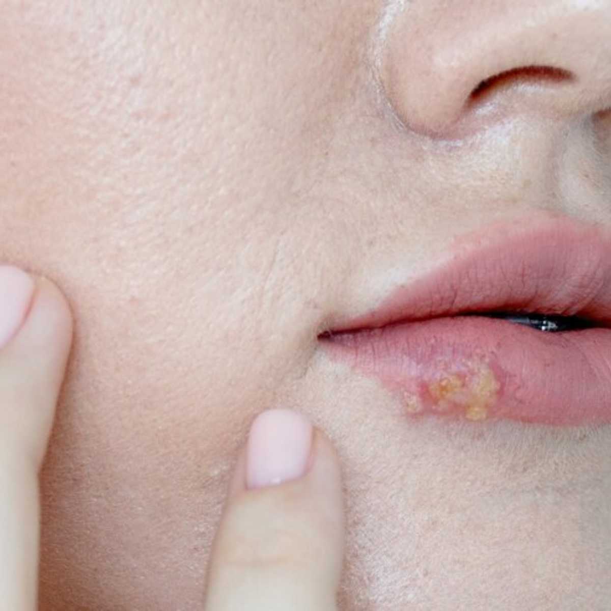 Gejala dan Tanda-Tanda Herpes Simpleks