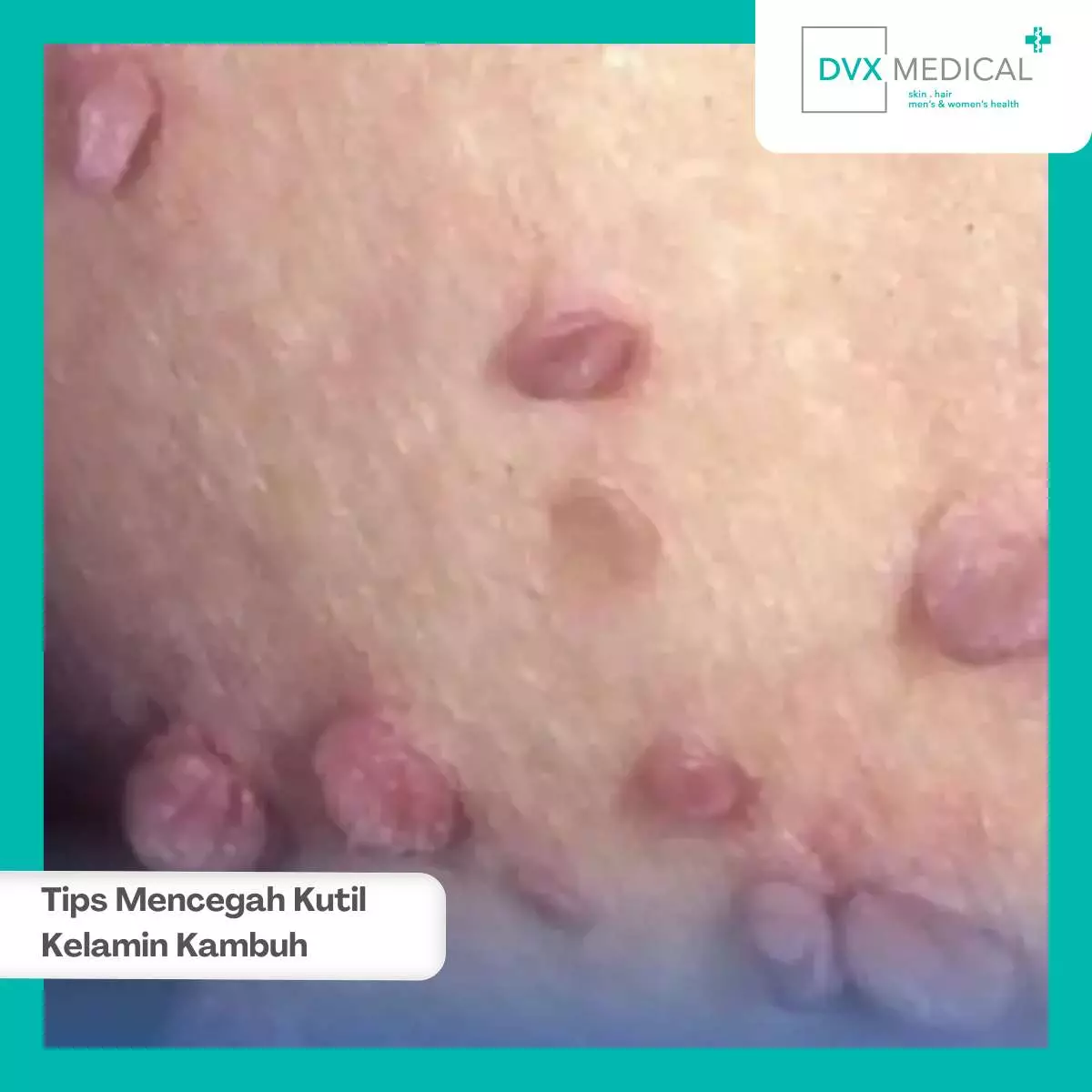 Apa Itu Kutil Kelamin dan Mengapa Bisa Kambuh?