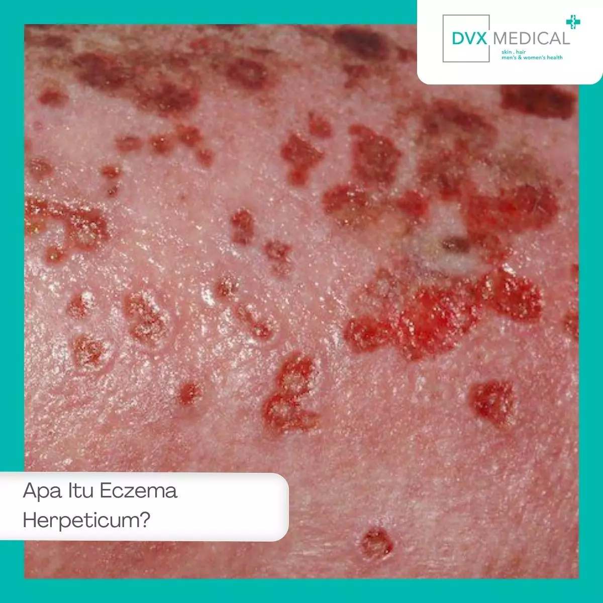 Apa Itu Eczema Herpeticum?