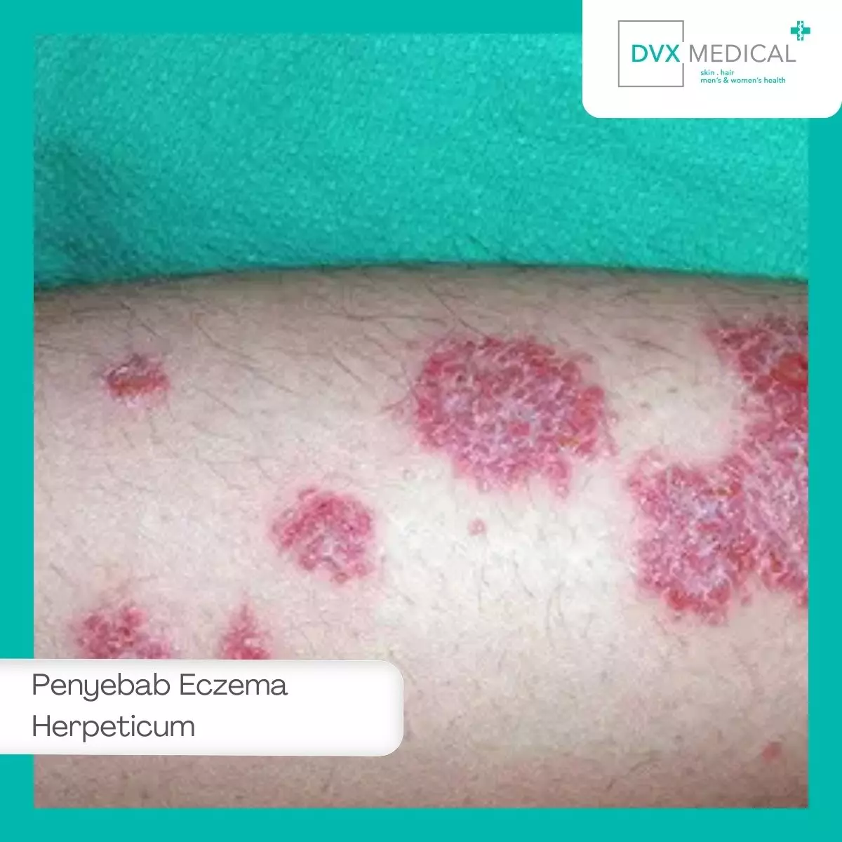 Penyebab Eczema Herpeticum