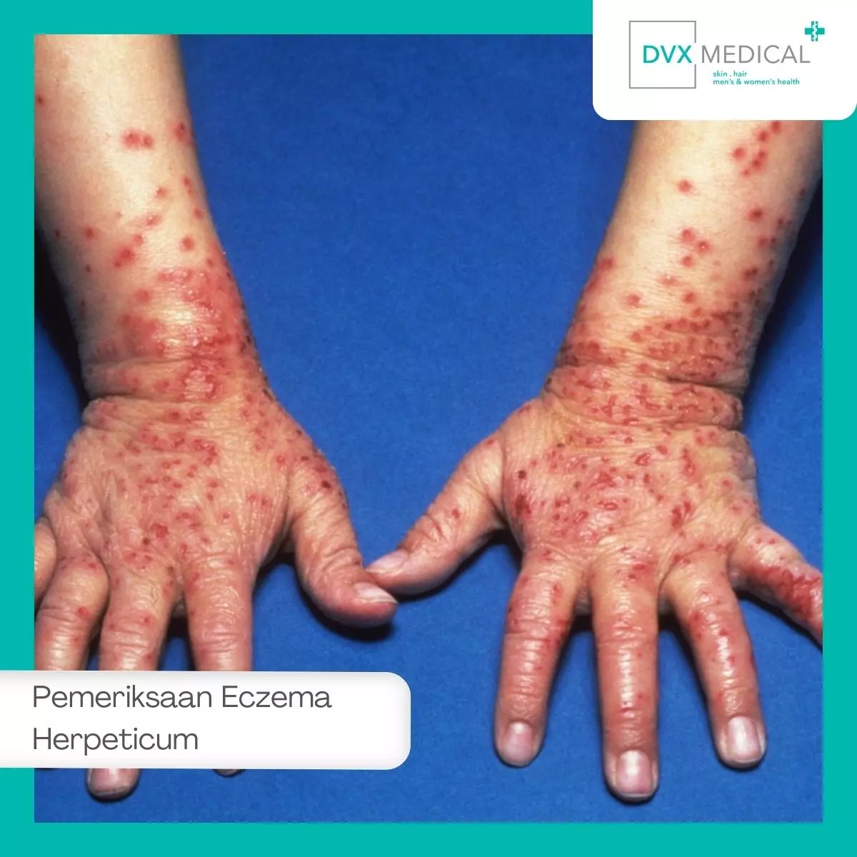 Bagaimana Cara Dokter Mendiagnosa Eczema Herpeticum?