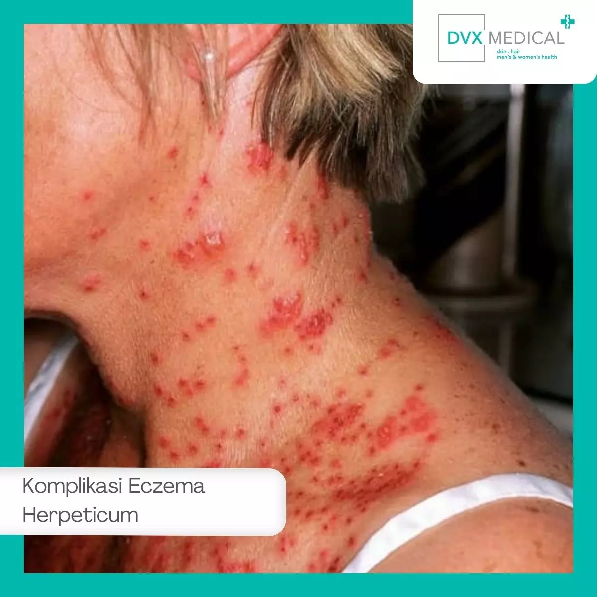 Komplikasi Eczema Herpeticum