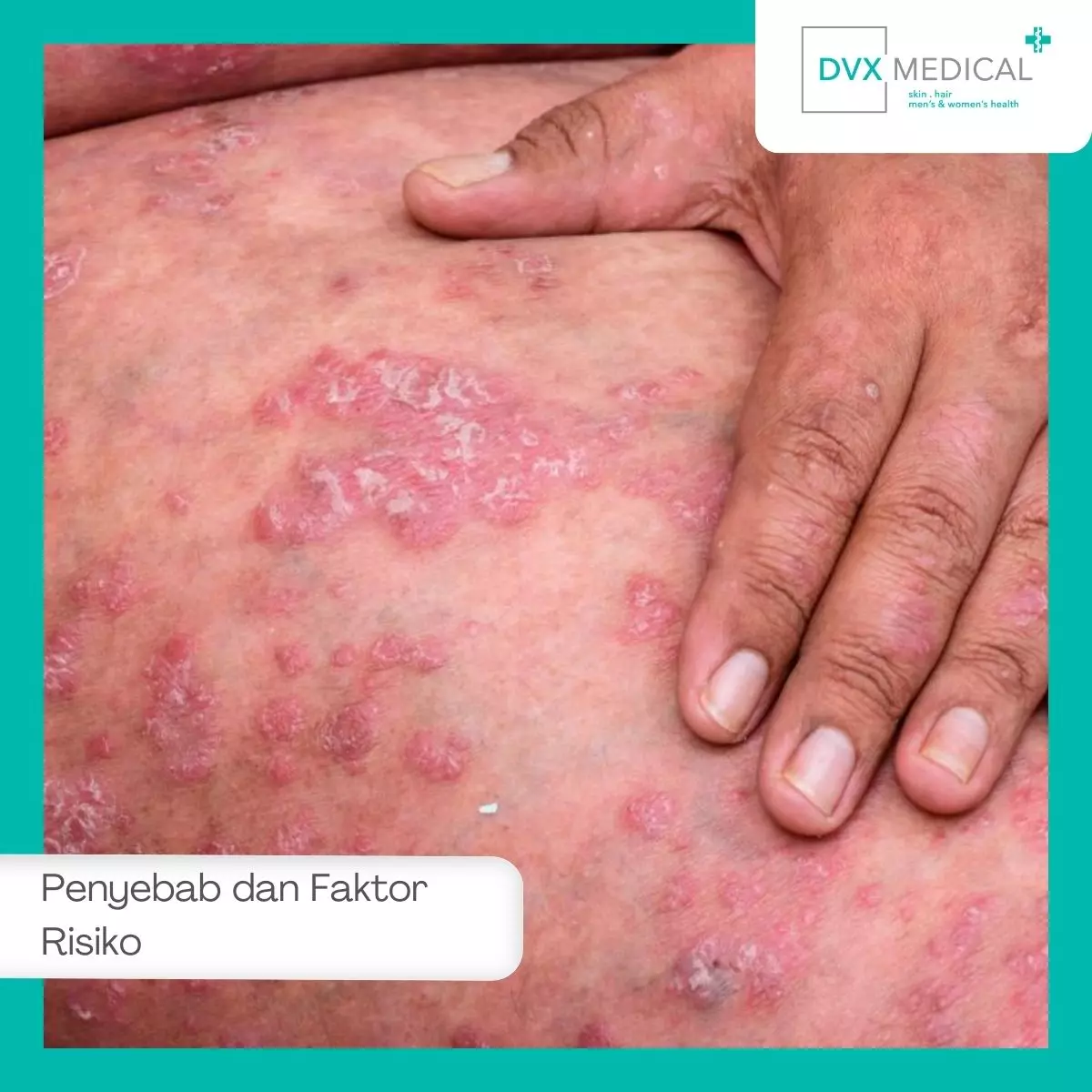Penyebab dan Faktor Risiko