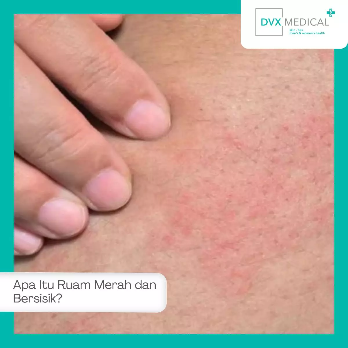 Apa Itu Ruam Merah dan Bersisik?