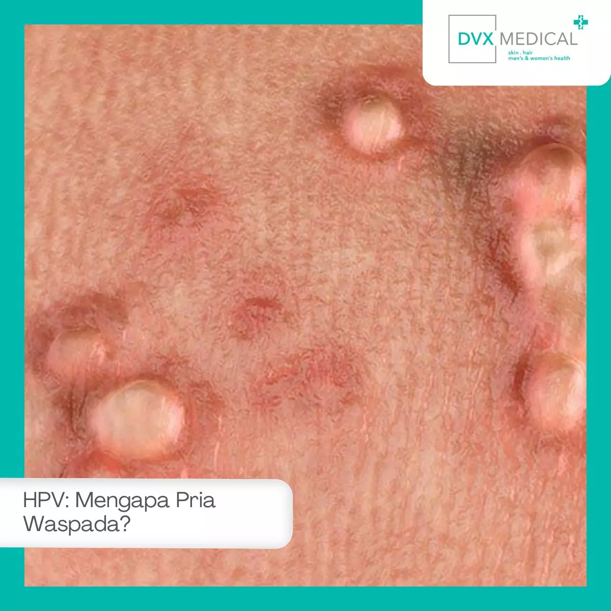 Apa Itu HPV dan Mengapa Pria Perlu Waspada?