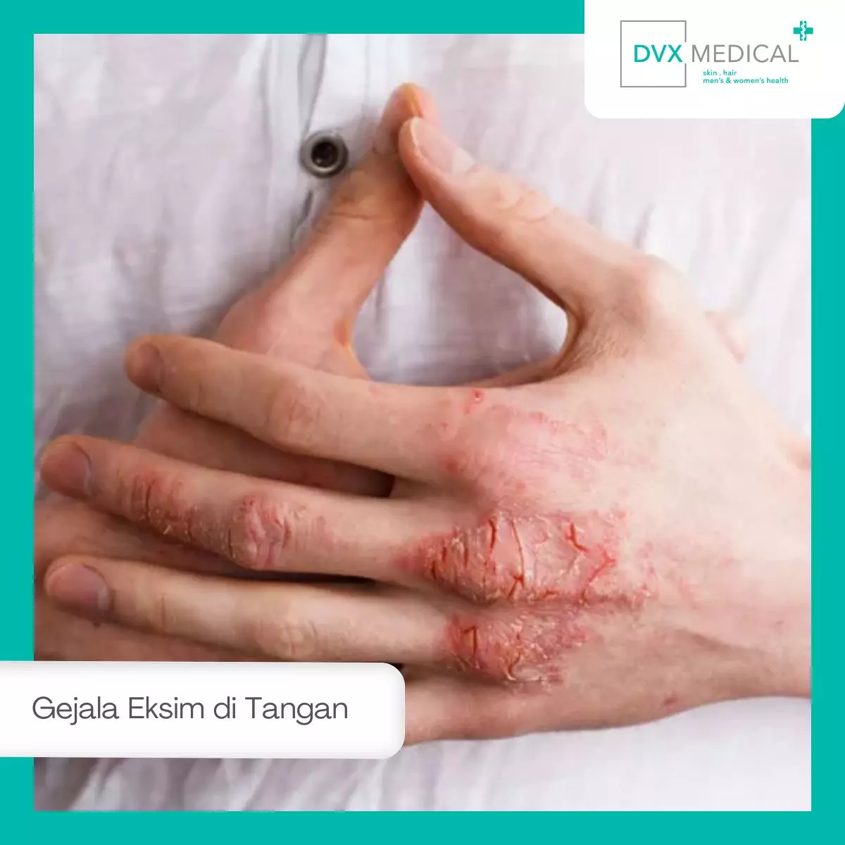 Gejala Eksim di Tangan