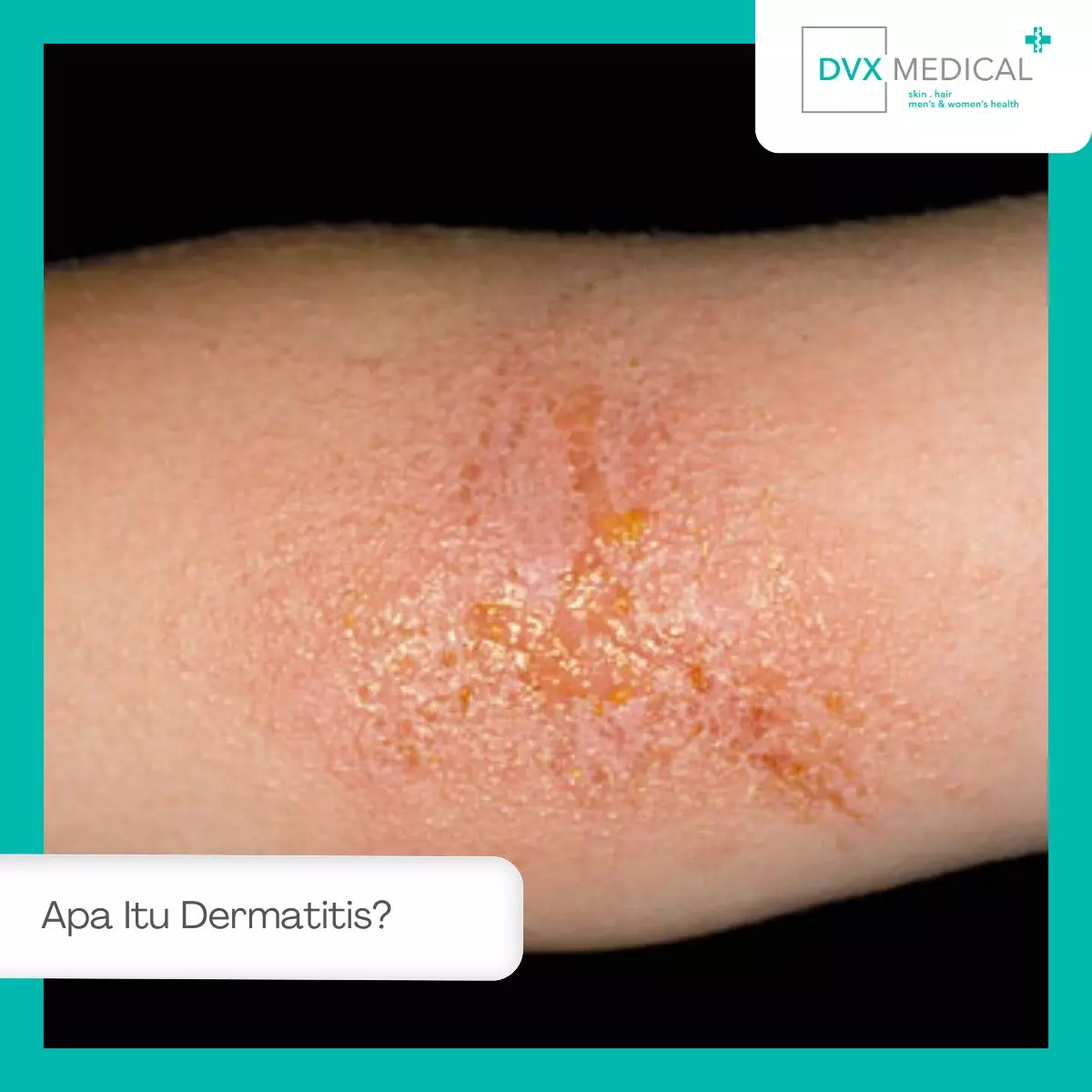 Apa Itu Dermatitis?