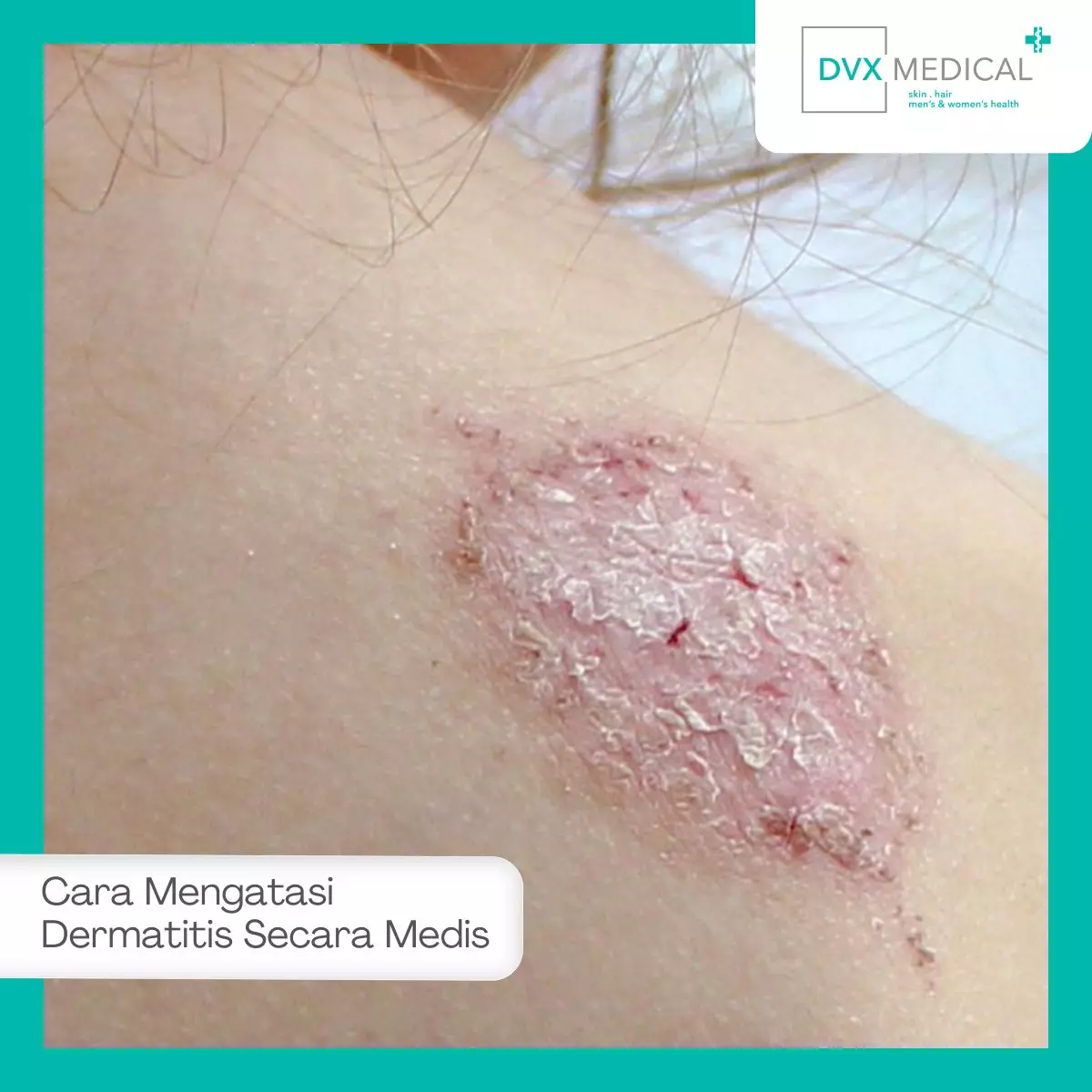 Cara Mengatasi Dermatitis Secara Medis