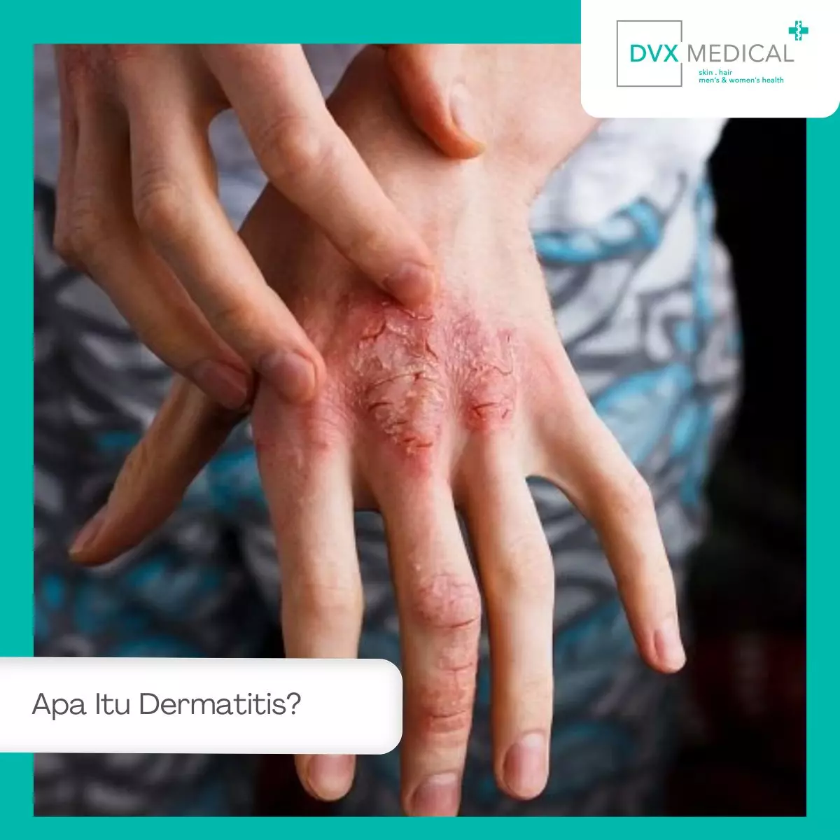 Apa Itu Dermatitis?