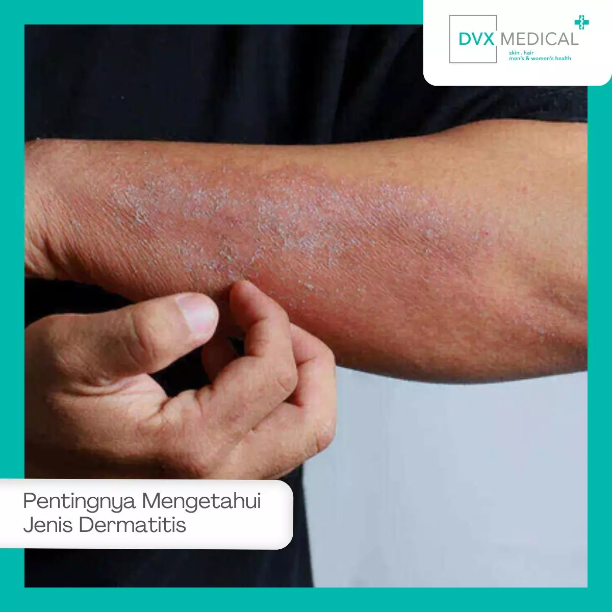 Mengapa Penting Mengetahui Jenis Dermatitis?