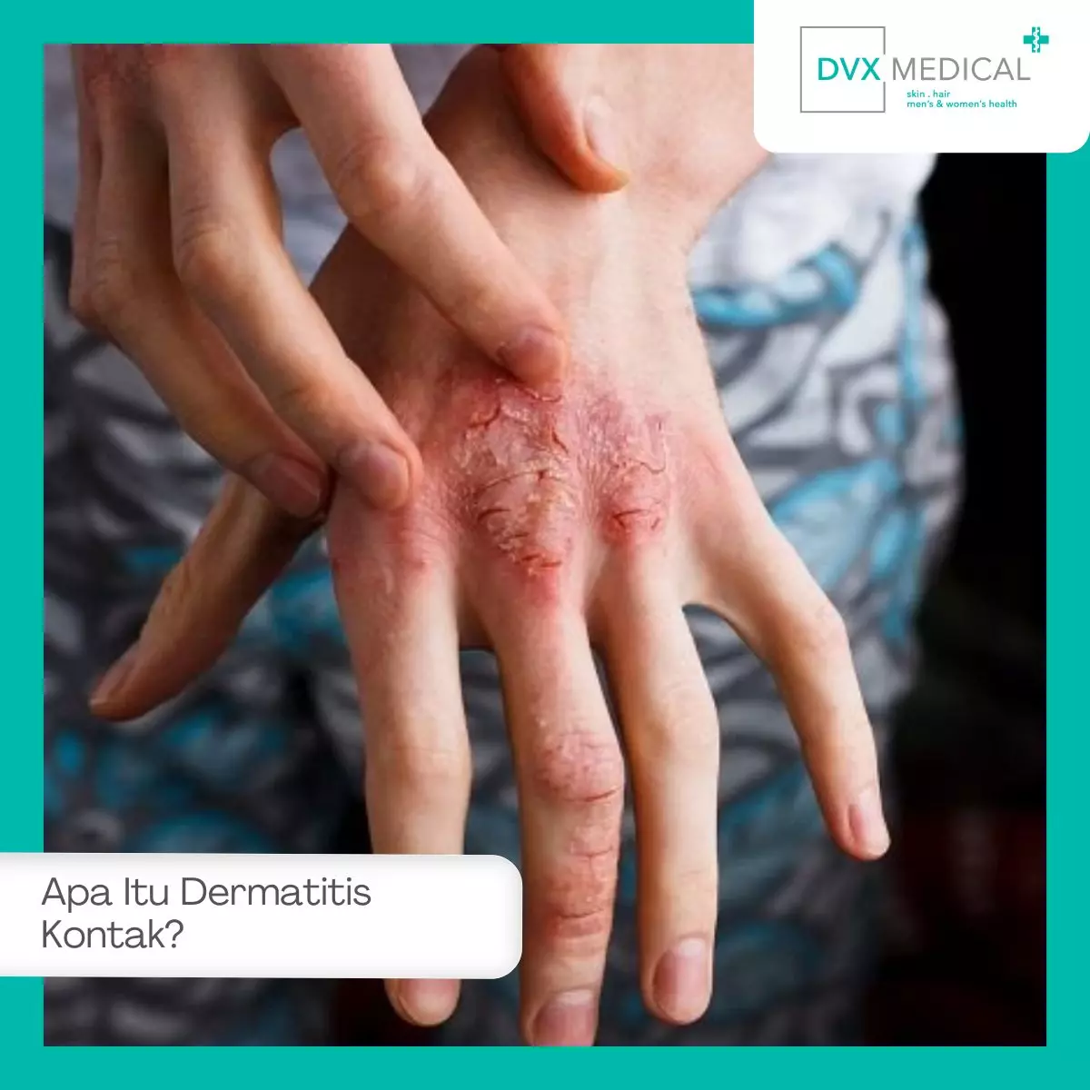 Apa Itu Dermatitis Kontak?