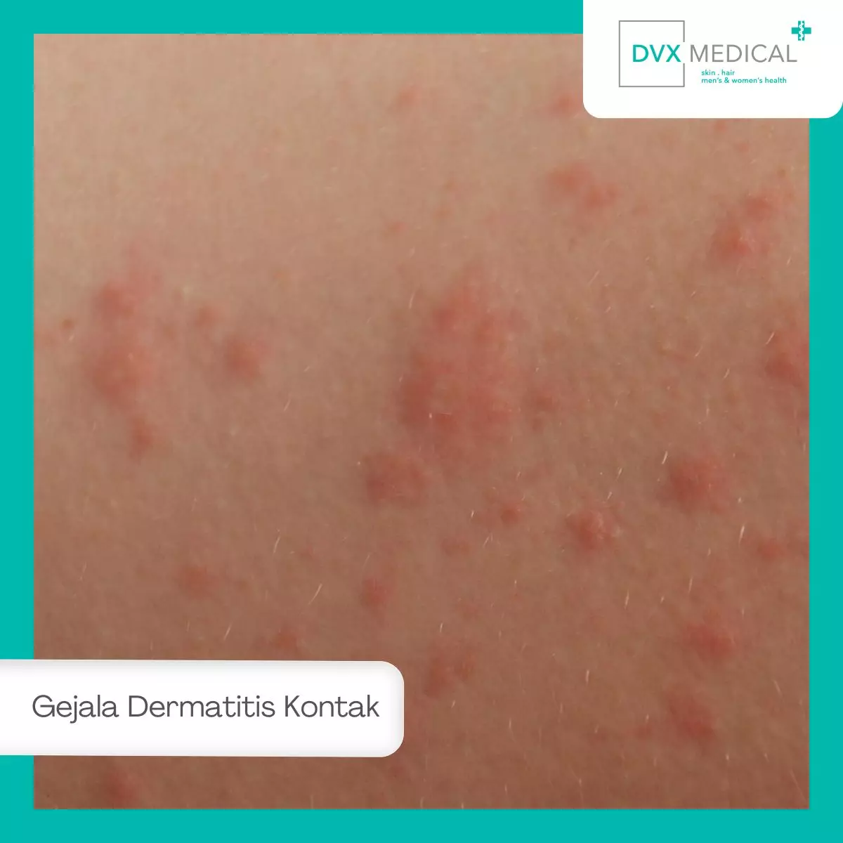 Gejala Dermatitis Kontak yang Perlu Diwaspadai