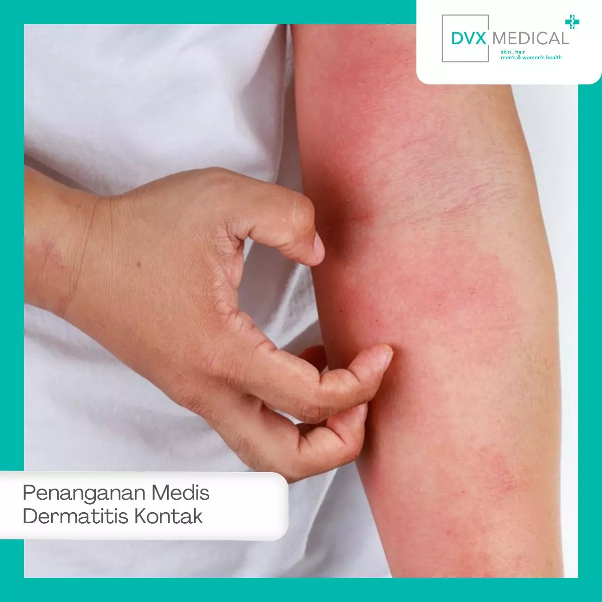 Penanganan Medis Dermatitis Kontak