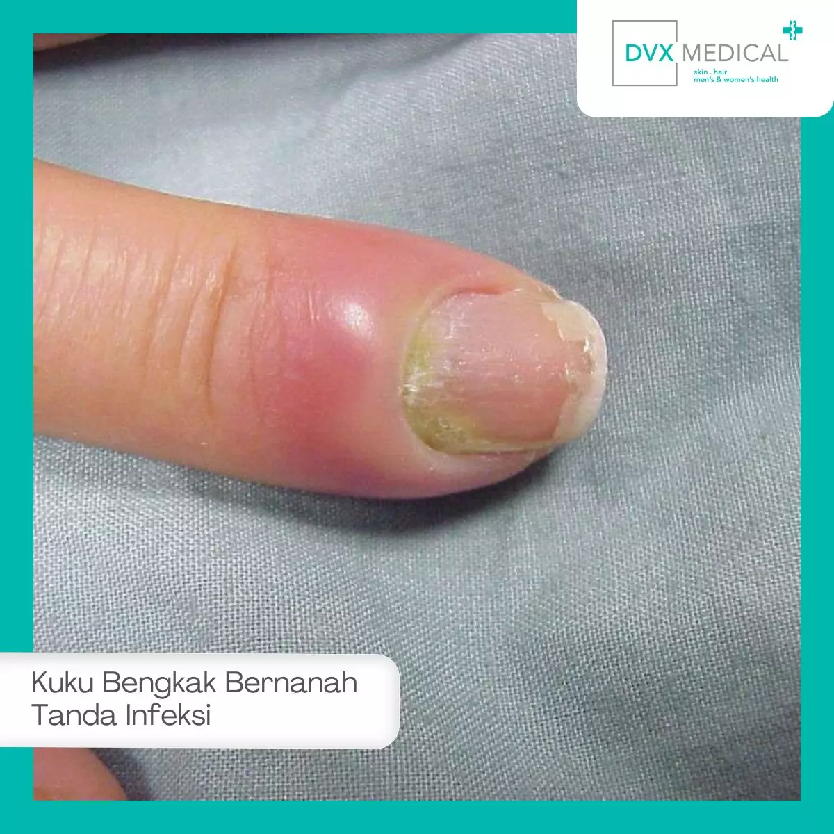 Kuku Bengkak dan Bernanah Bisa Jadi Tanda Infeksi