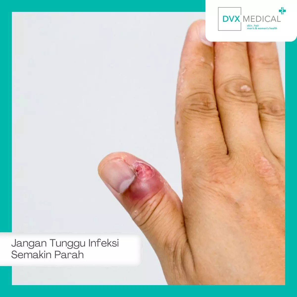 Jangan Tunggu Infeksi Semakin Parah
