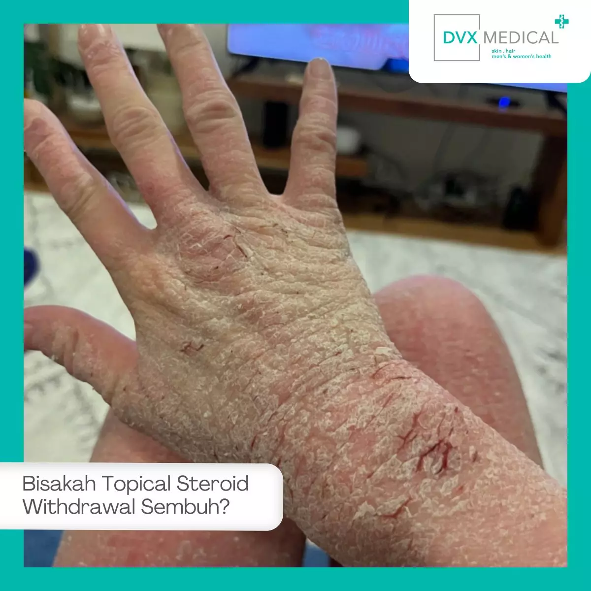 Apakah Topical Steroid Withdrawal Bisa Sembuh?