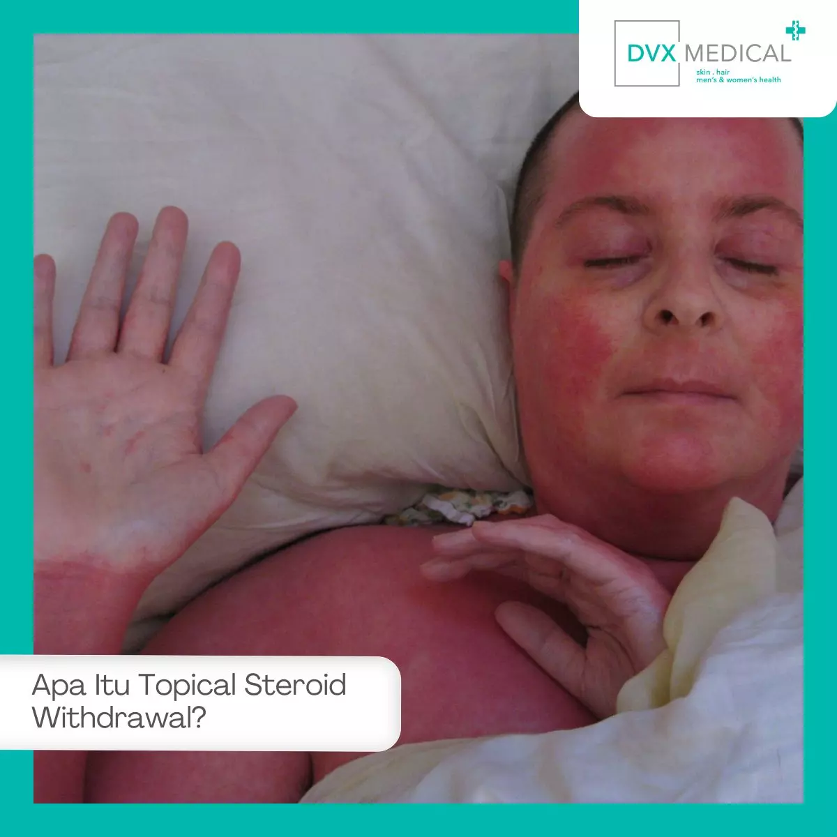 Apa Itu Topical Steroid Withdrawal?