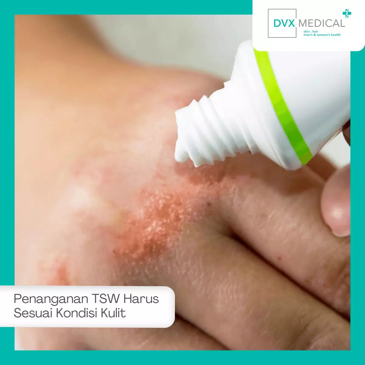 Penanganan TSW Harus Sesuai Kondisi Kulit