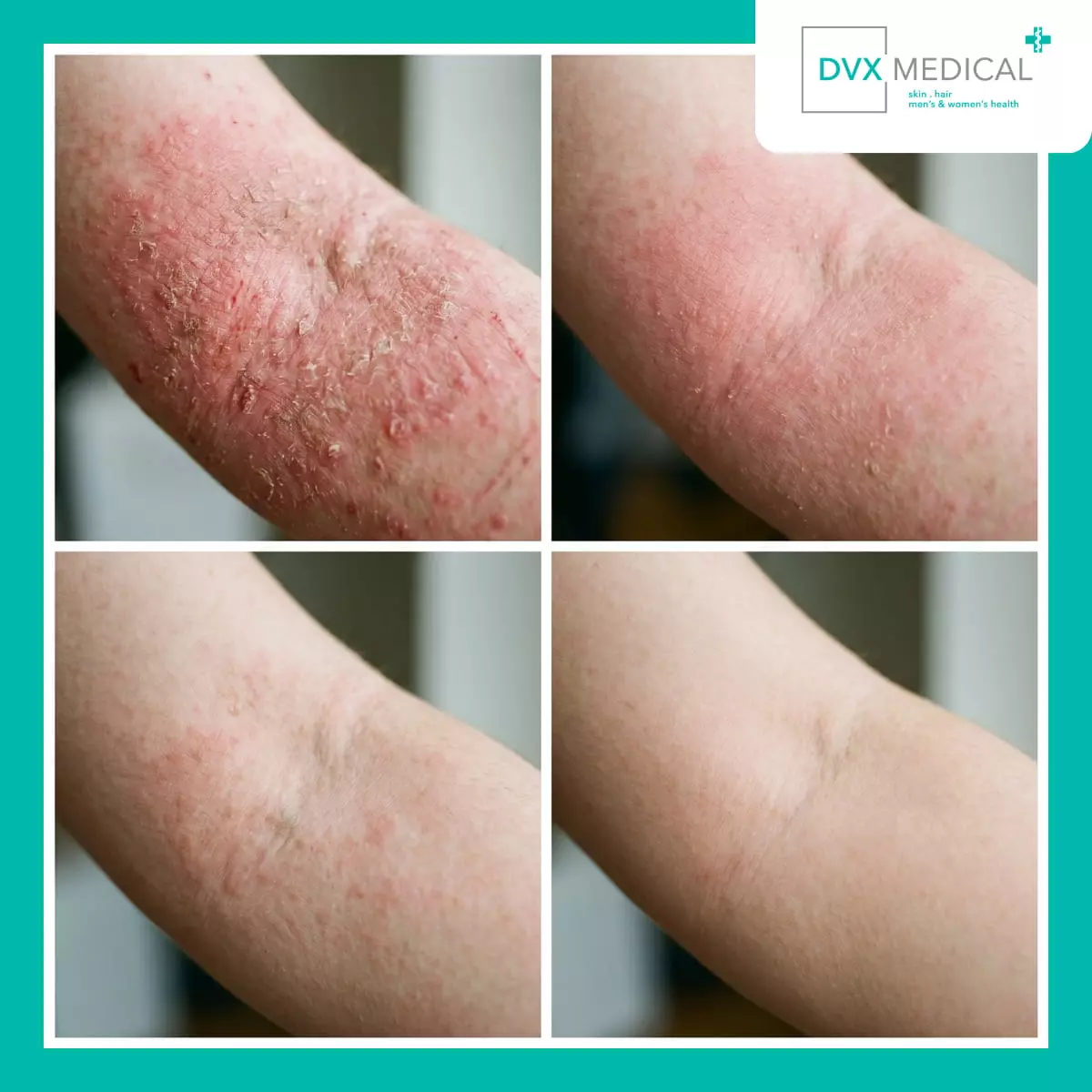 Apa yang Berubah Setelah Dupixent (Dupilumab) Mulai Bekerja?