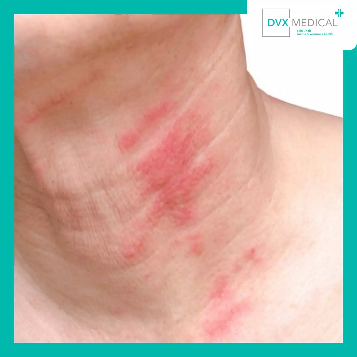 Apa yang Terjadi di Dalam Kulit pada Dermatitis Atopik