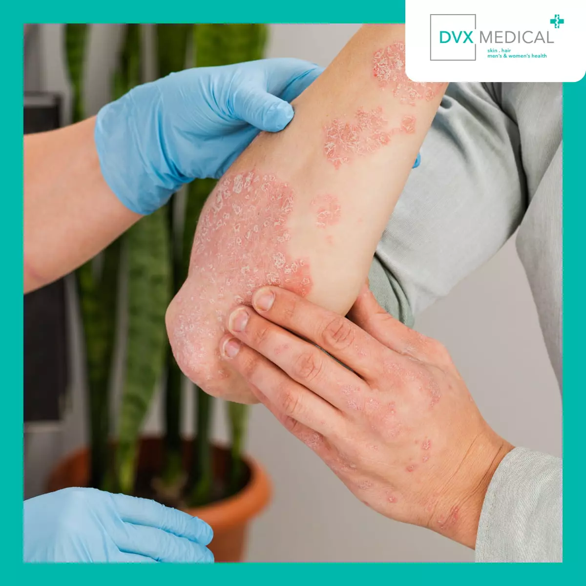 Dermatitis Atopik Adalah Penyakit Kronis