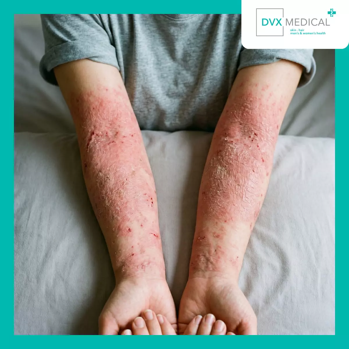 Apa yang Membuat Dermatitis Atopik Disebut Berat?