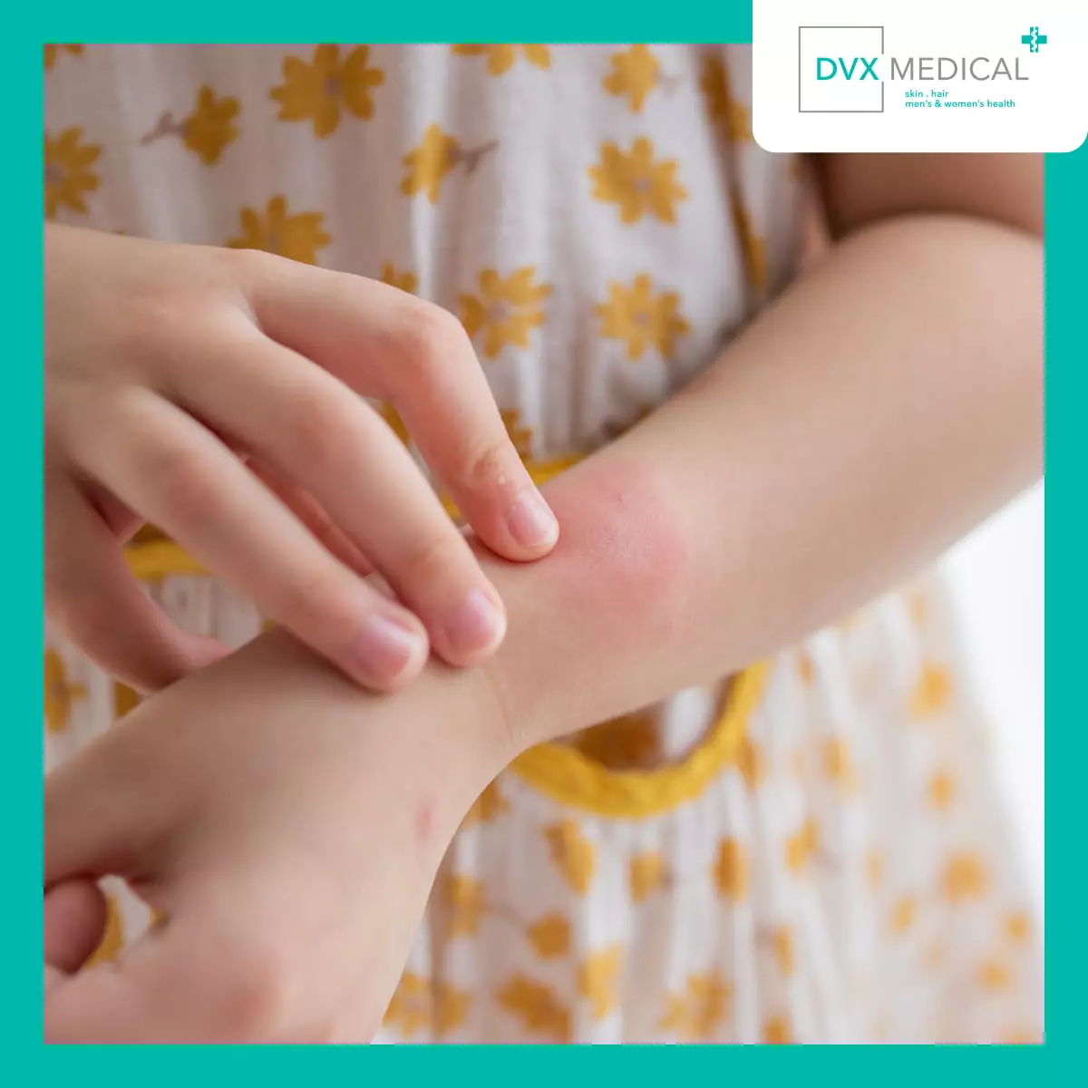 Siapa yang Bisa Mengalami Dermatitis Atopik?