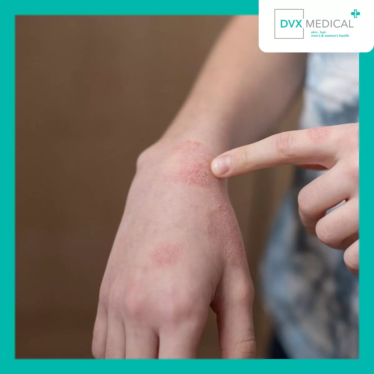 Bagaimana Tampilan Dermatitis Atopik pada Kulit Asia?