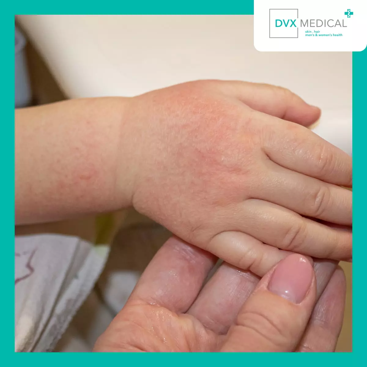 Apa Saja Gejala Dermatitis Atopik?