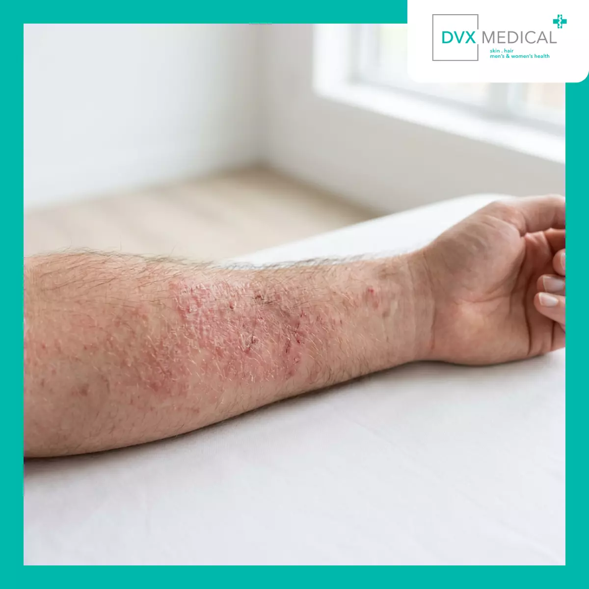 Dermatitis Atopik Tidak Memiliki Satu Penyebab Tunggal