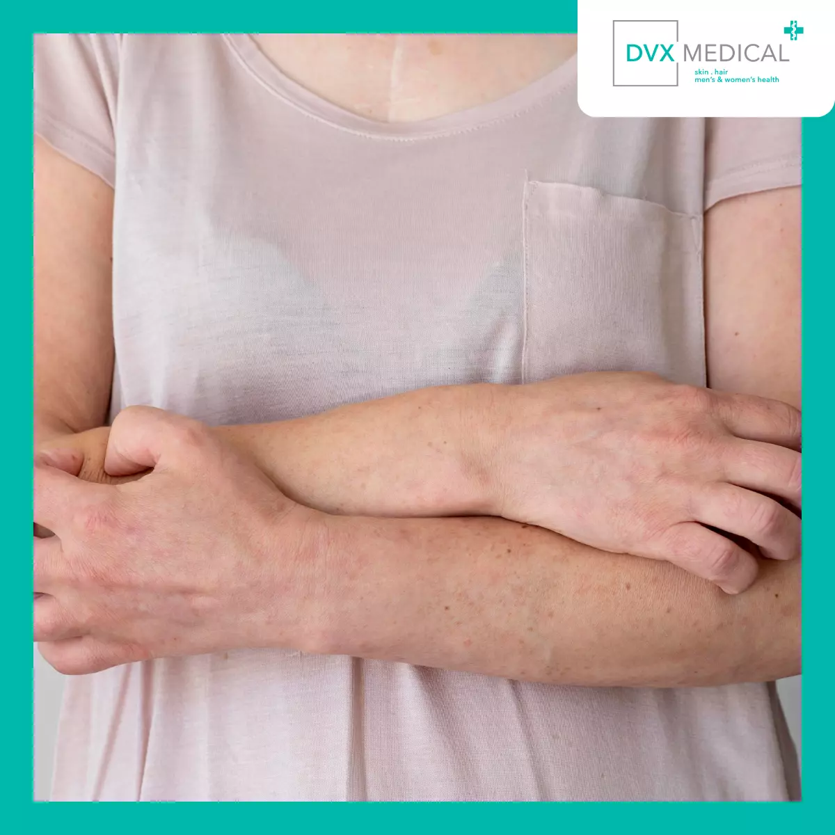 Mengapa Banyak Orang Mengira Dermatitis Atopik Adalah Penyakit Autoimun?
