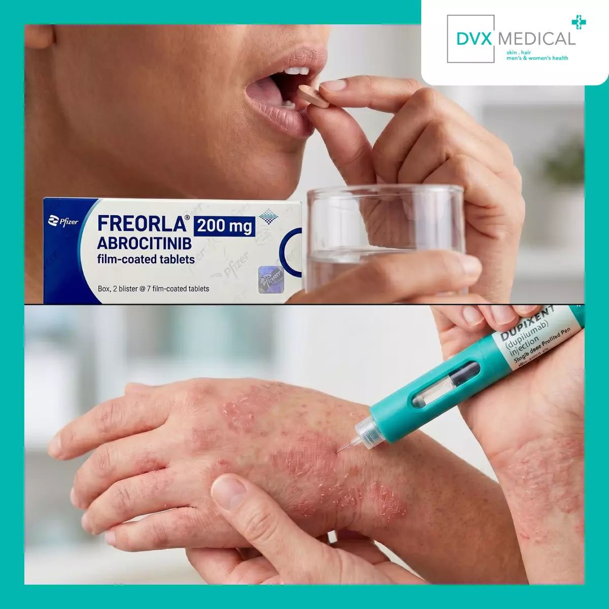 Kapan Dupixent (dupilumab) Lebih Sering Menjadi Pertimbangan?