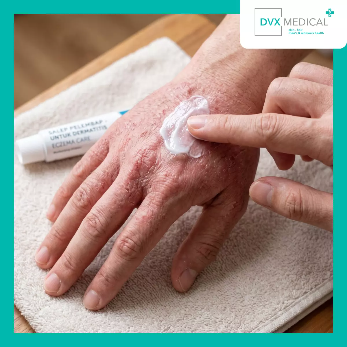 Kapan Dermatitis Atopik Tidak Lagi Cukup Ditangani dengan Terapi Topikal?