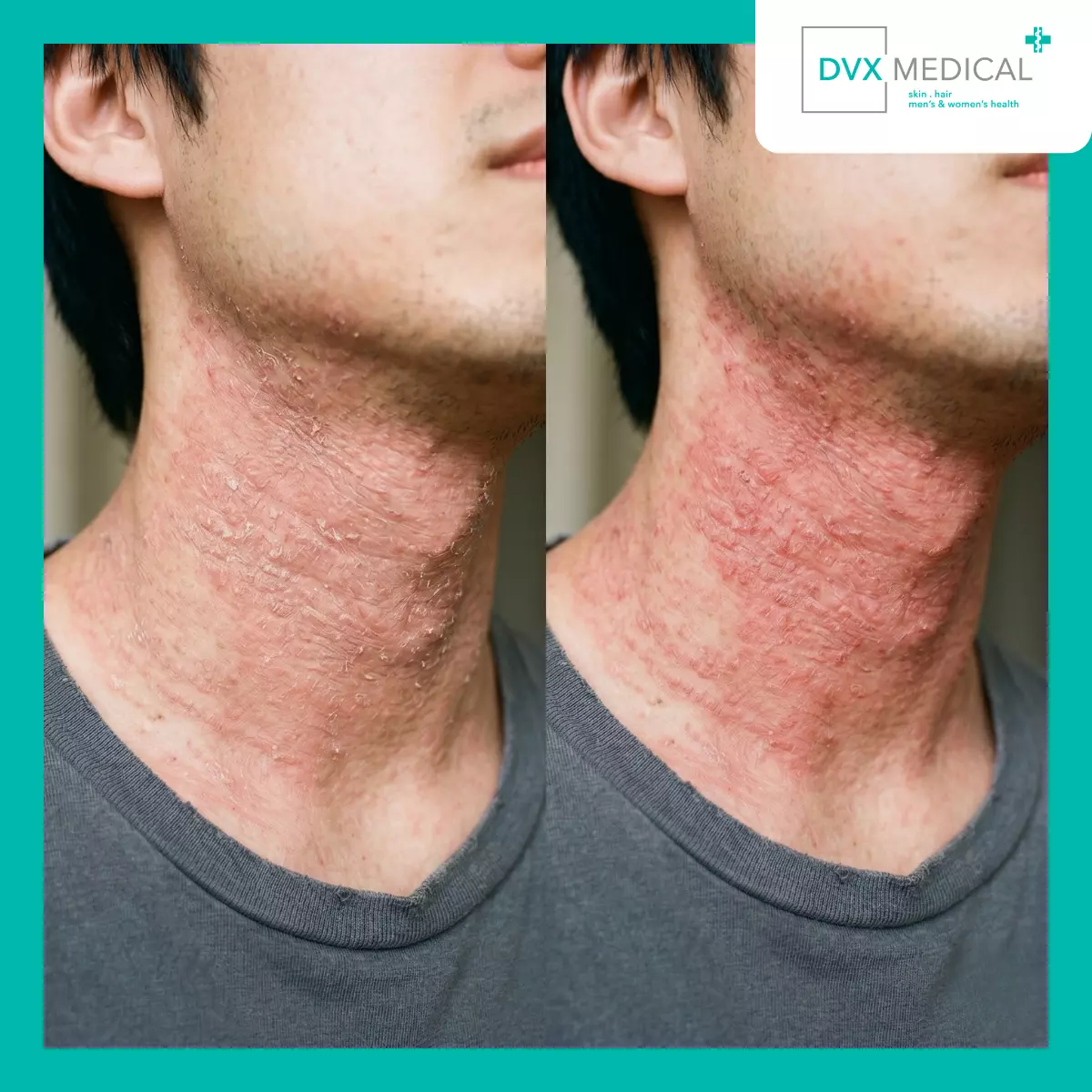 Mengapa TSW dan Dermatitis Atopik yang Tidak Terkontrol Bisa Terlihat Mirip?