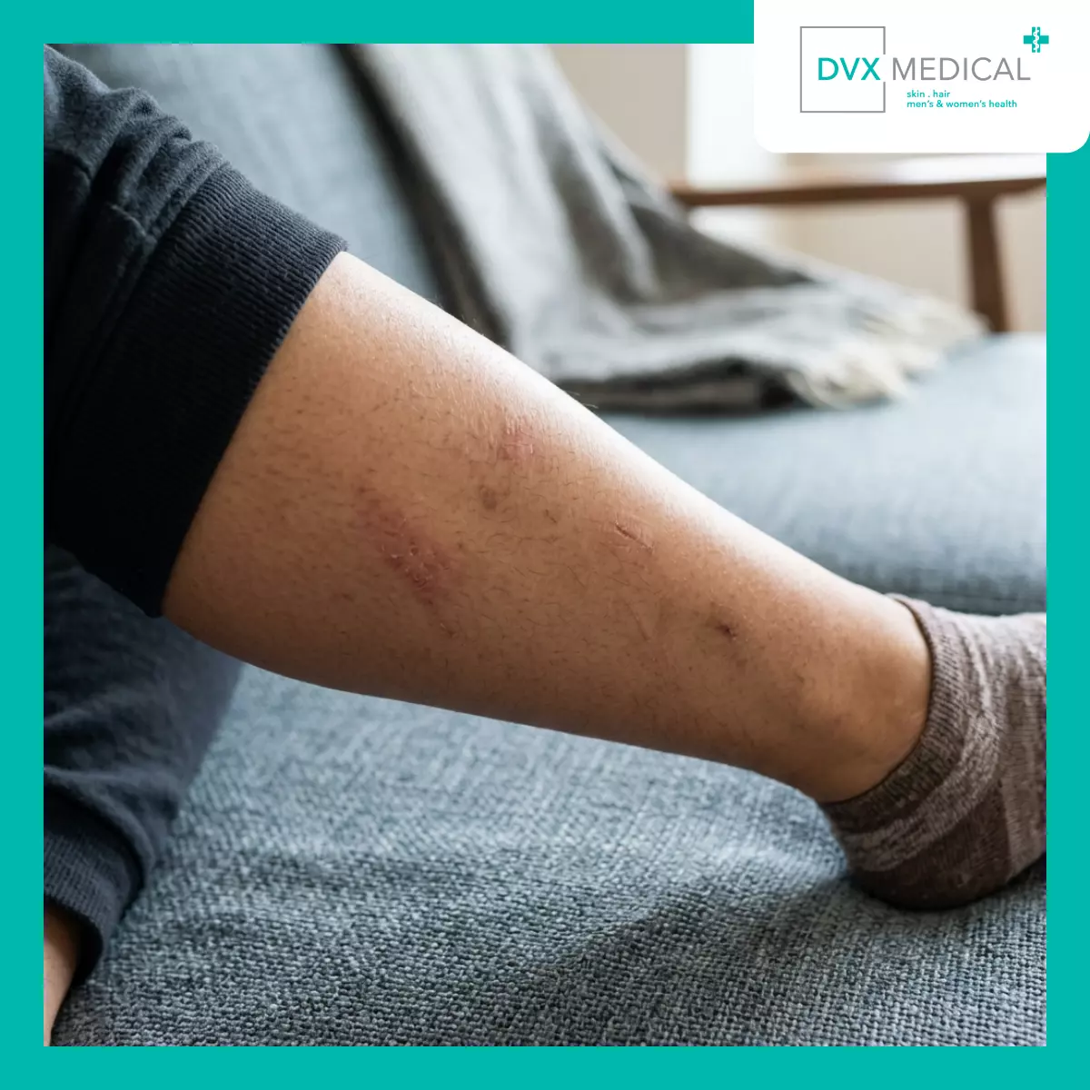 Mengapa Eksim di Kaki Sering Meninggalkan Bekas?