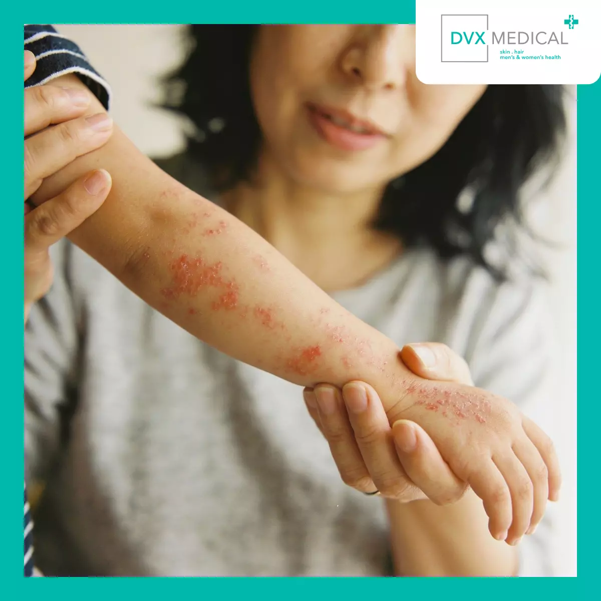 Apakah Dermatitis Atopik Menular ke Orang Lain?